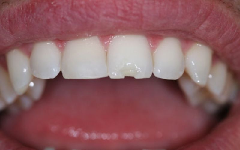 Bọc răng sai kỹ thuật, chất liệu kém dễ gây sứt mẻ